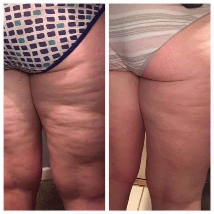 Antes y después lipedema