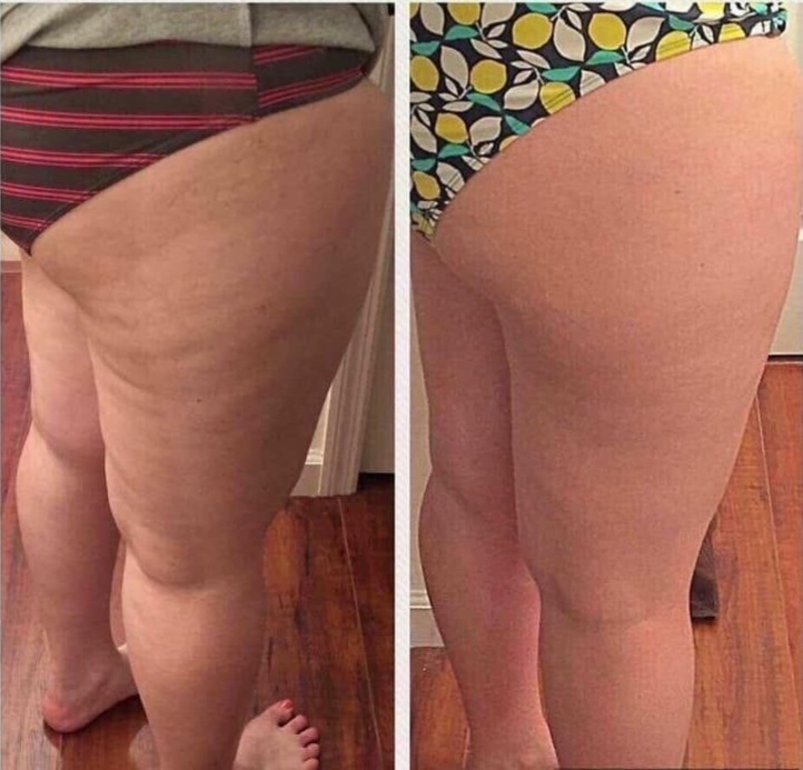 Resultado protocolo lipedema