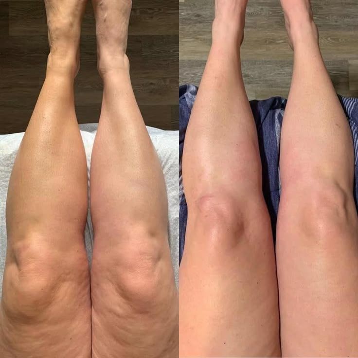 Transformación lipedema 14 días